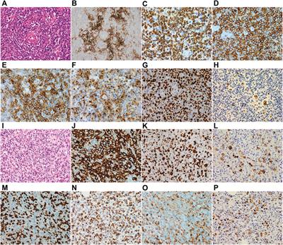 Case Report: Immune Microenvironment and Mutation Features in a Patient With Epstein–Barr Virus Positive Large B-Cell Lymphoma Secondary to Angioimmunoblastic T-Cell Lymphoma